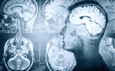 1 de cada 5 pacientes con epilepsia focal de reciente comienzo puede tener anomalías estructurales cerebrales como causa de sus crisis. La importancia de un buen diagnóstico a tiempo.