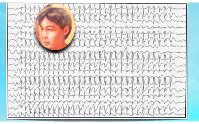 ¿Por qué es importante el videoEEG prolongado en el diagnostico de las crisis de ausencia?