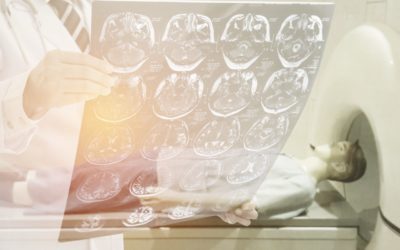 ¿Cómo cambia el cerebro en personas con epilepsia generalizada mal controlada?