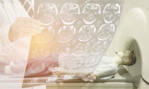 ¿Cómo cambia el cerebro en personas con epilepsia generalizada mal controlada?